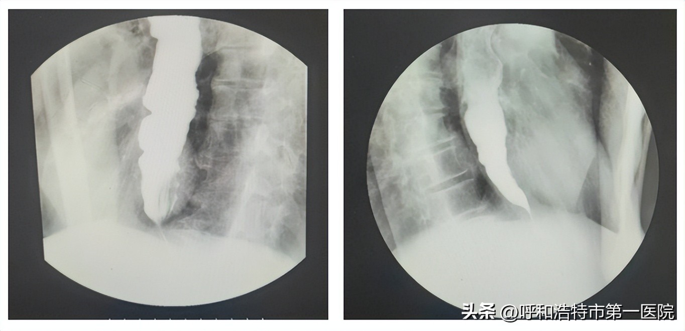 消化内科与消化内镜微创手术,贲门失弛缓症消化内科手术全过程