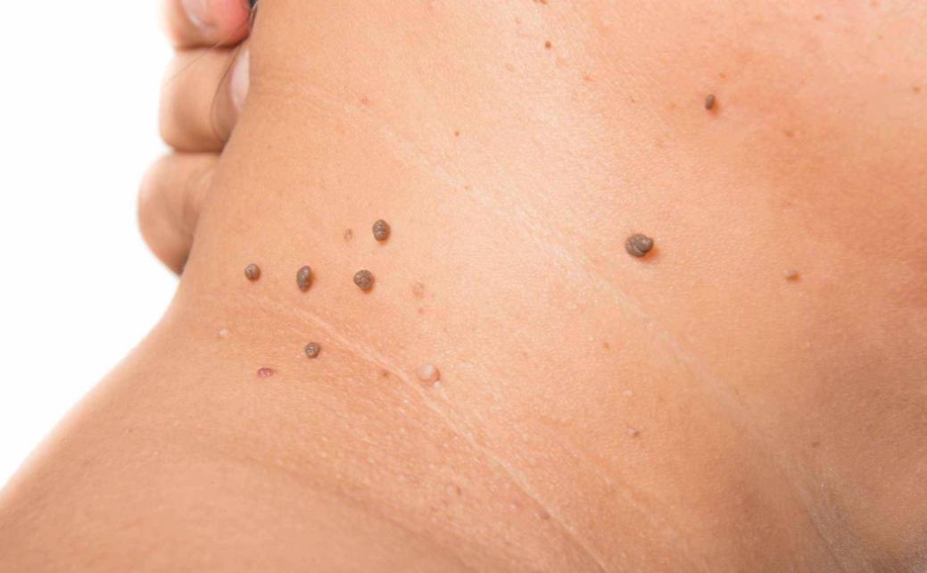 人身上有瘊子怎么处理,身上五种疣可能是hpv感染