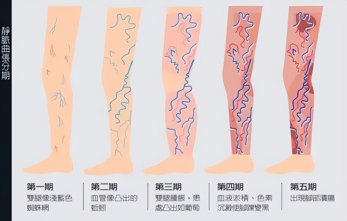 皮肤溃疡能彻底根治吗,皮肤溃疡最快解决方法