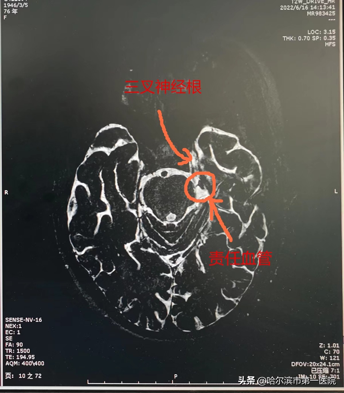 七旬大娘吃饭都“费劲”原是三叉神经痛难“张口”哈尔滨市第一医院神经二外科微血管减压术解除患者十年顽疾