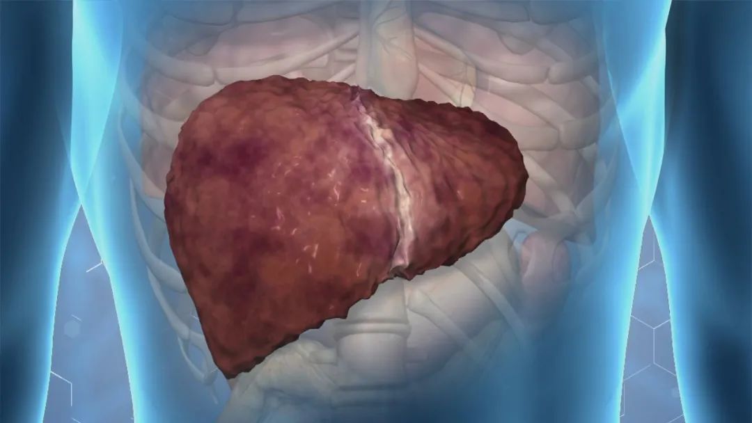 55岁重度酒精肝酗酒成瘾会怎么样,55岁得了酒精肝硬化还能活多久