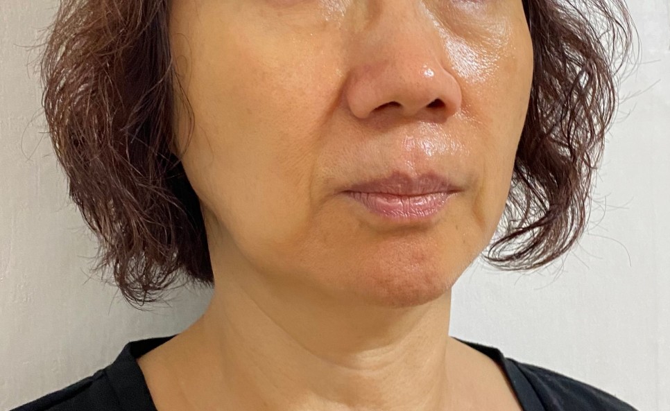 拉皮成功整容案例,拉皮提升面部手术对比图