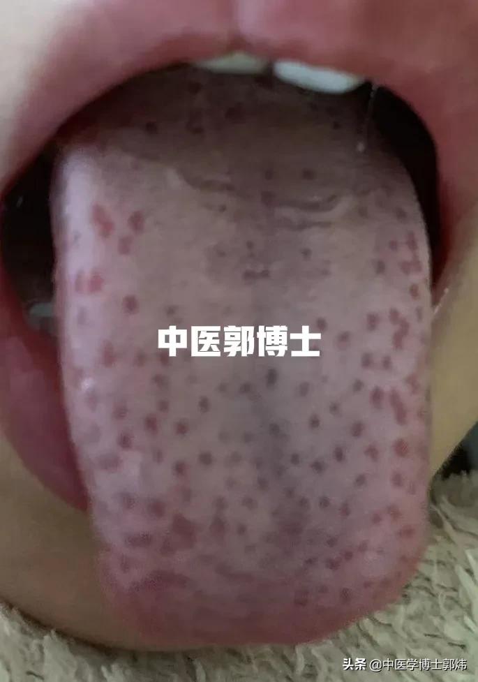 高烧反复吃药就退药效过了就烧,高烧导致脾有炎症