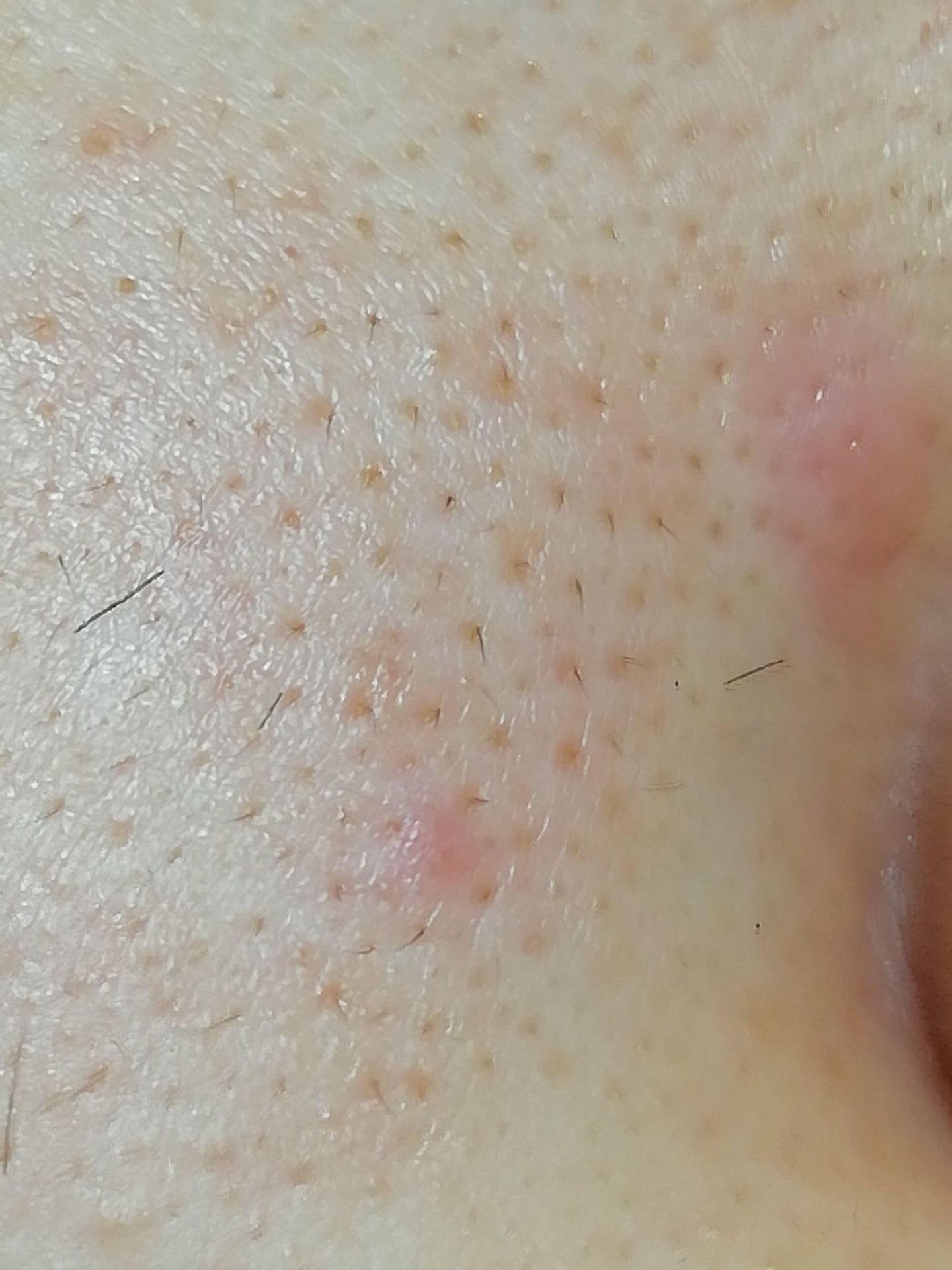 真黑头假黑头傻傻分不清楚，怎么去黑头？