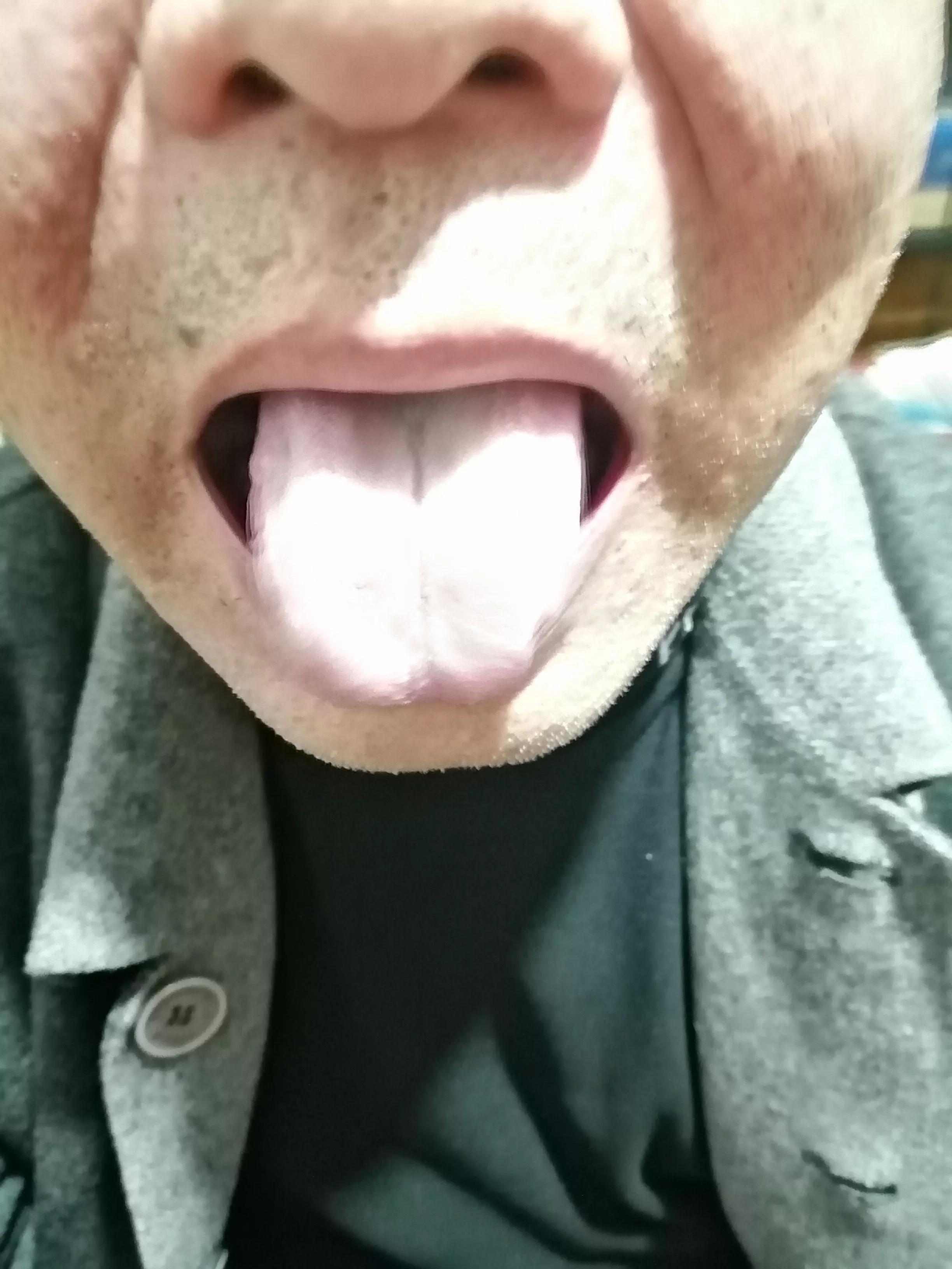 颈椎病病例分析康复治疗,颈椎病引起手麻图大全