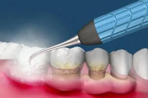 洗牙后怎么保持牙齿永久干净,洗牙对牙齿有什么好处和坏处图片