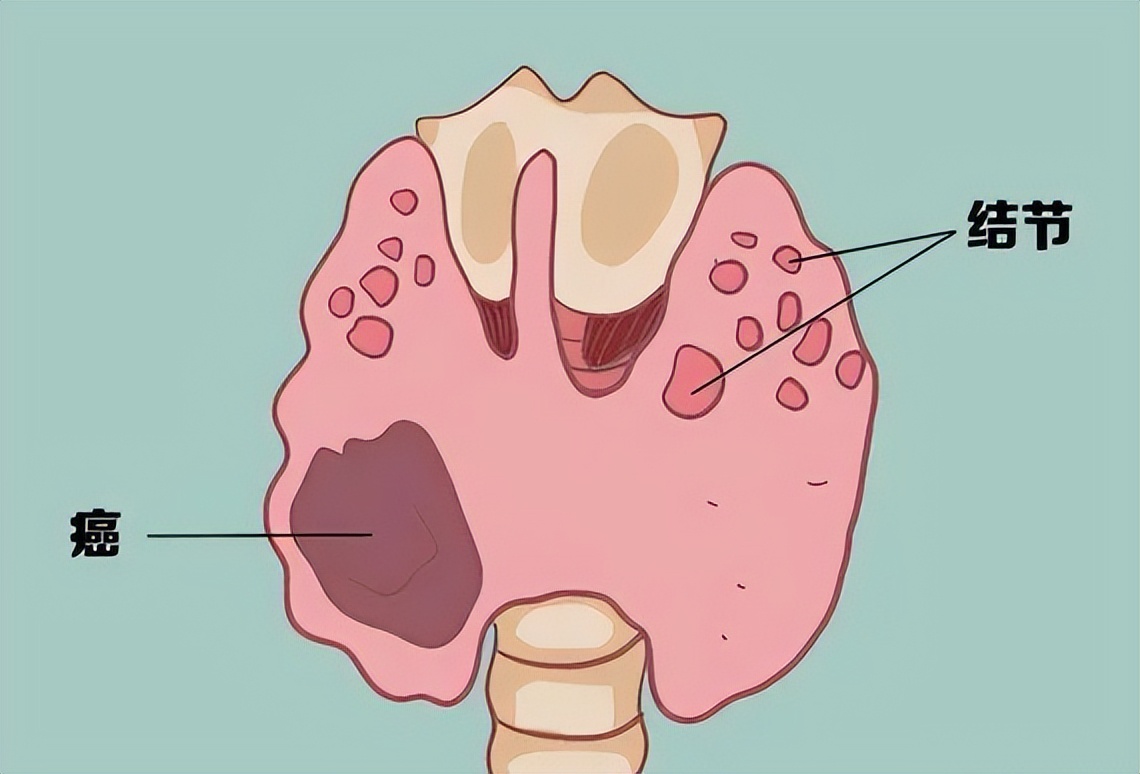 冯提莫谈甲状腺癌晚期手术多少钱,冯提莫自曝患甲状腺癌晚期