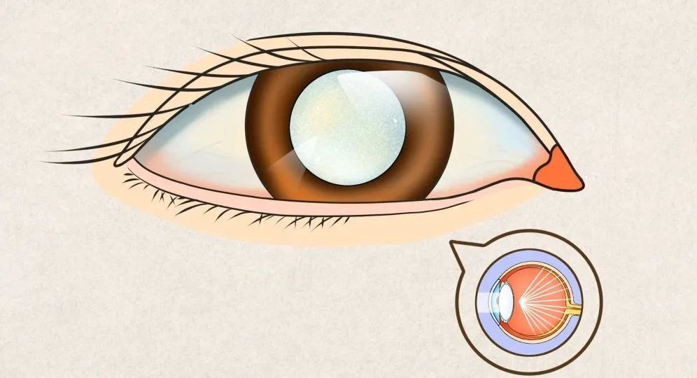 白内障久拖不治成弱视,白内障一直不做手术有什么后果