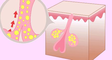 油性黑头毛孔粗大护肤的正确步骤,混干皮黑头多毛孔大