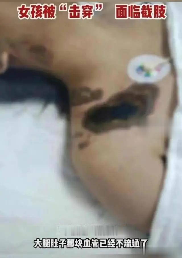 女孩充电玩苹果手机遭电击,女孩充电时玩手机被电击面临截肢