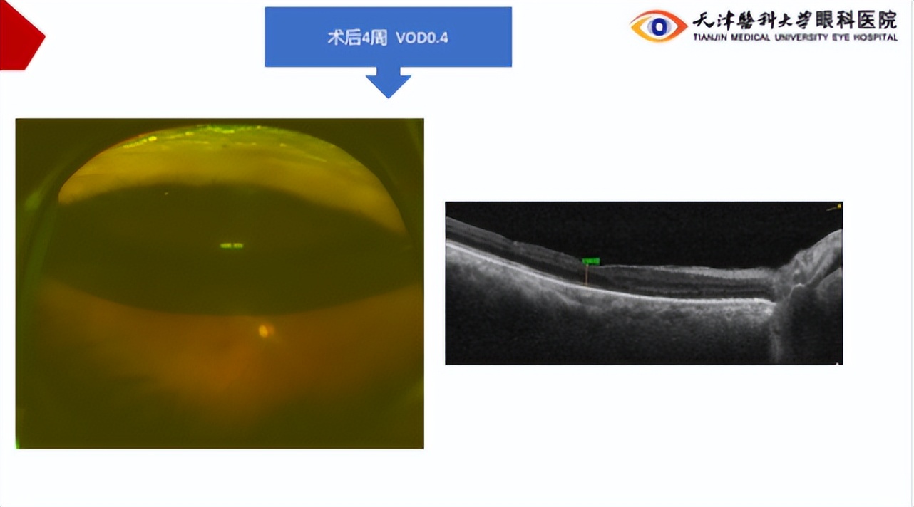 李筱荣教授,天津医科大学眼科医院李筱荣