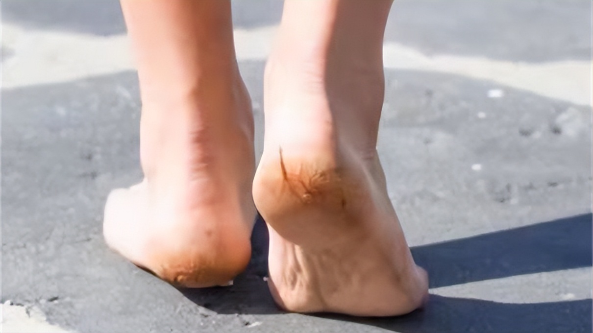 脚后跟干裂可能与这4个原因有关,脚后跟总干裂原来是这3个原因
