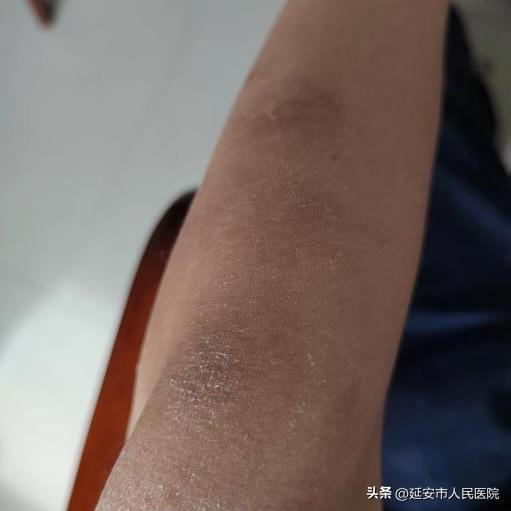 感染新冠皮肤能变好吗,新冠病毒可以通过皮肤感染吗