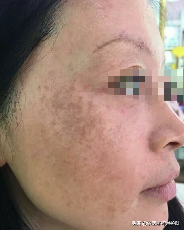 色斑也得分类别,从中医角度浅谈色斑成因,这样治疗更有效
