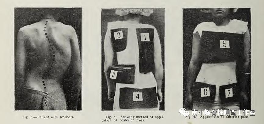 gbw硬质支具矫正脊柱侧弯,gbw支具案例