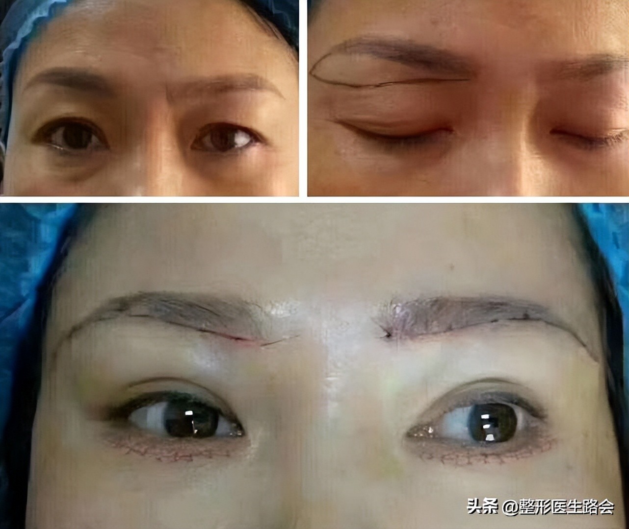 脸干有细纹显老,脸部皮肤黑显老怎么办