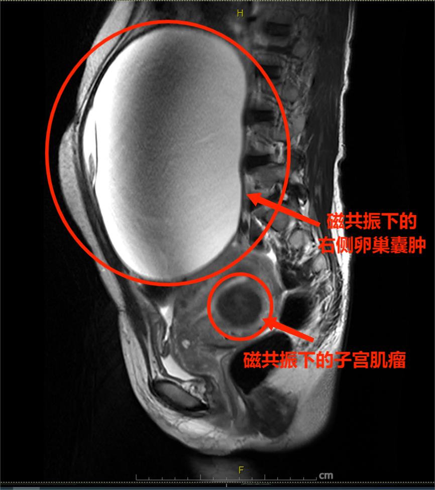 腹中长了个巨大囊肿,腹部鼓鼓的像怀孕一样