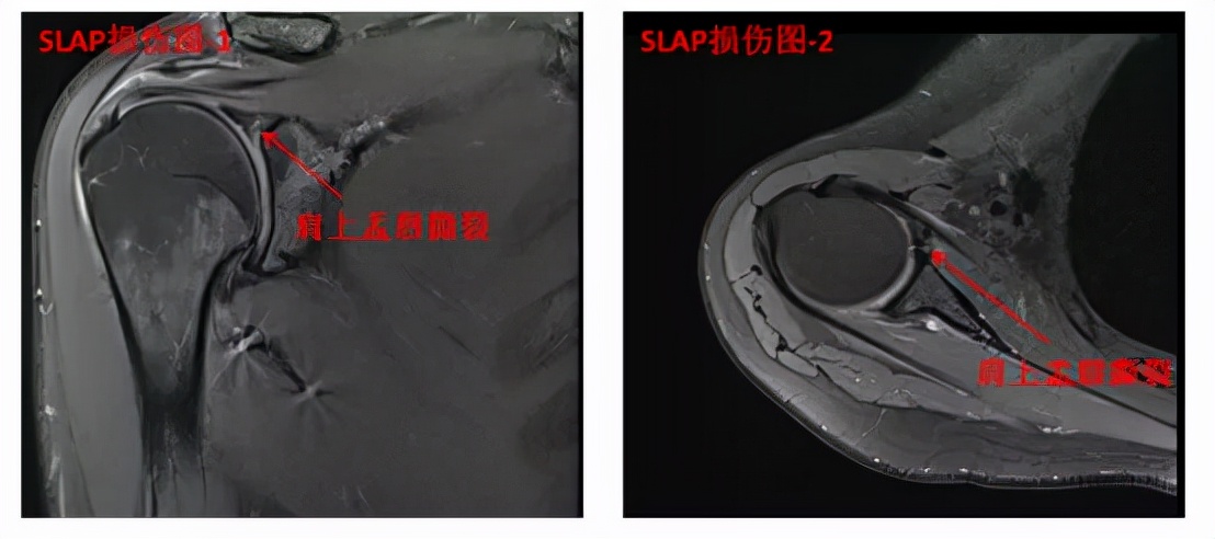 老是肩膀难受咋回事,肩膀痛要怎么缓解