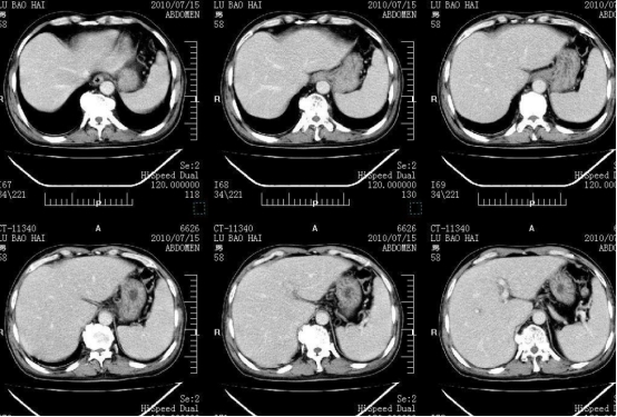 补充叶酸和维生素B6，可有效预防脑梗死，科学服用注意4点