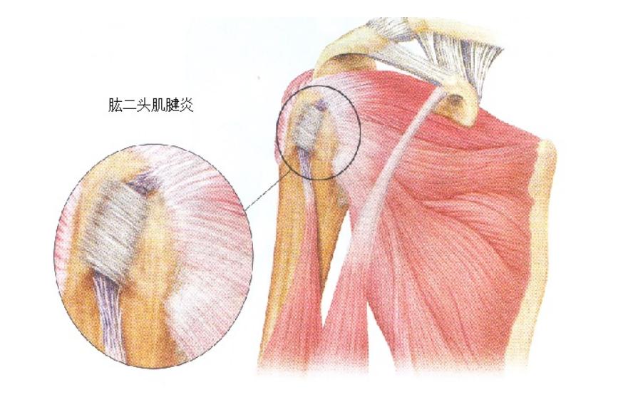 肱二头肌长头肌腱炎和肩周炎鉴别,肱二头肌肌腱炎用什么中药