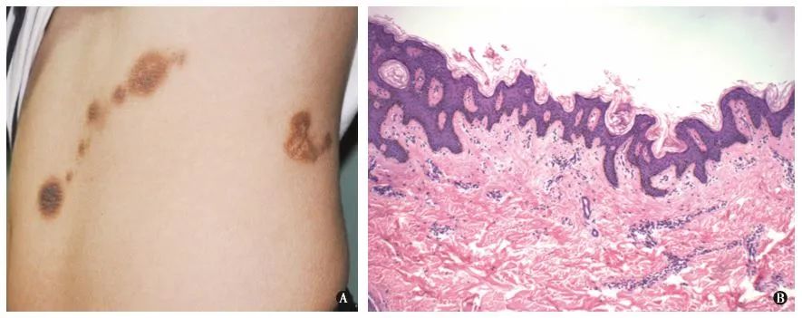 肥胖引起的黑棘皮图片,重度肥胖人黑棘皮病能彻底治好吗