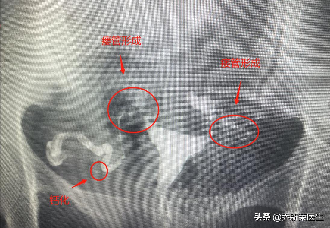 哪种造影可以查输卵管结核,怎么能确定输卵管有结核