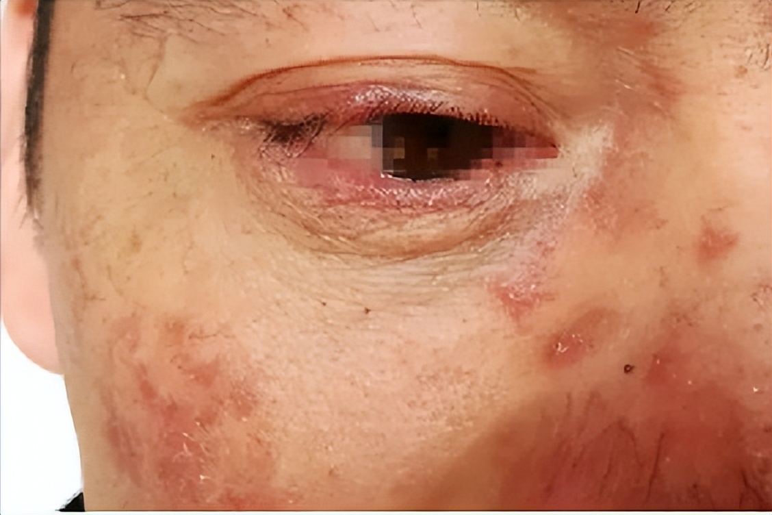 面部皮炎的症状和治疗方法,面部皮炎是怎么回事