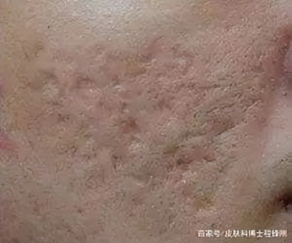 背上长痘痘留下黑色疤痕怎么办,长痘痘后留下的疤痕怎么办