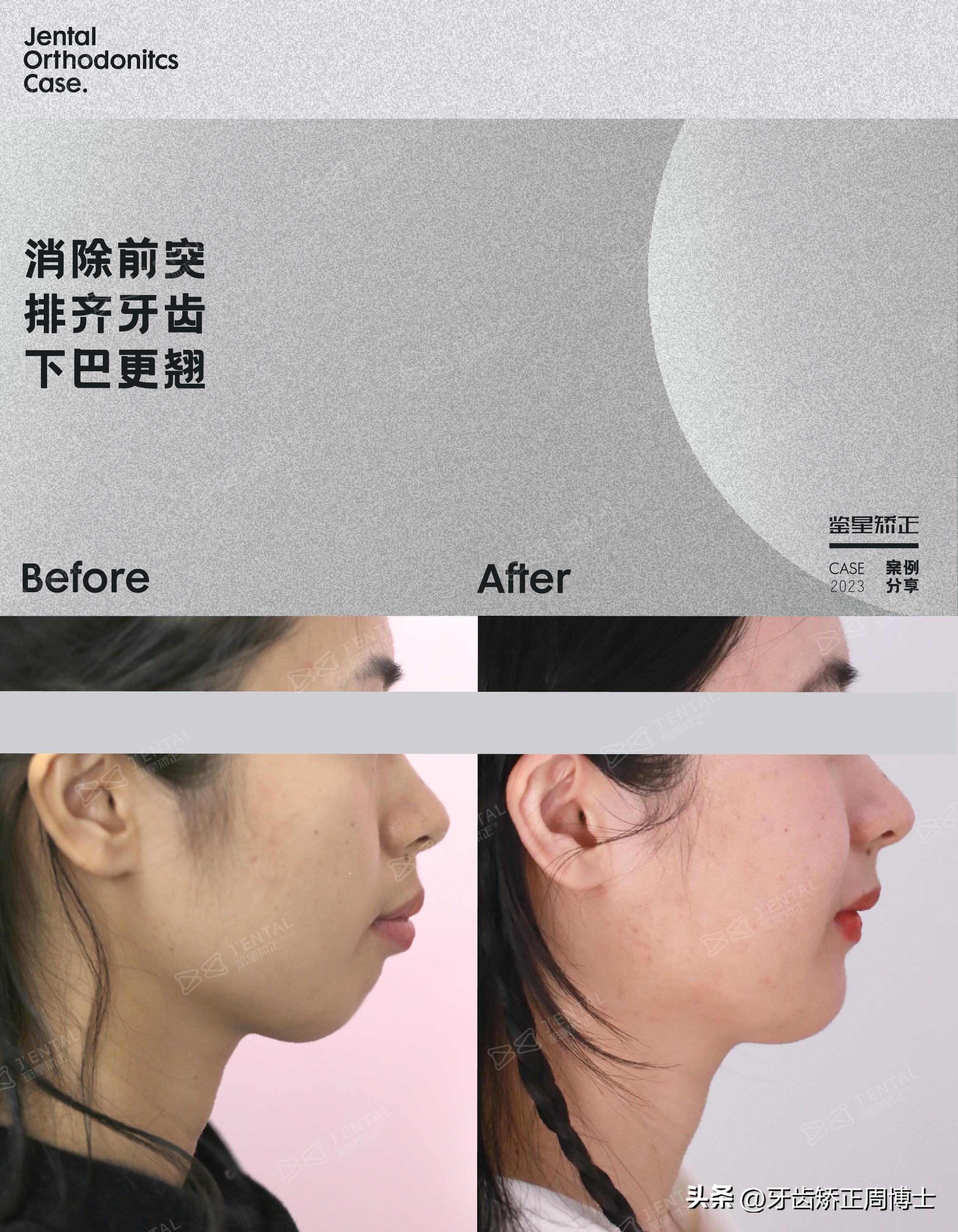 骨性前突下巴后缩可以矫正吗,上颌骨前突下巴后缩如何矫正