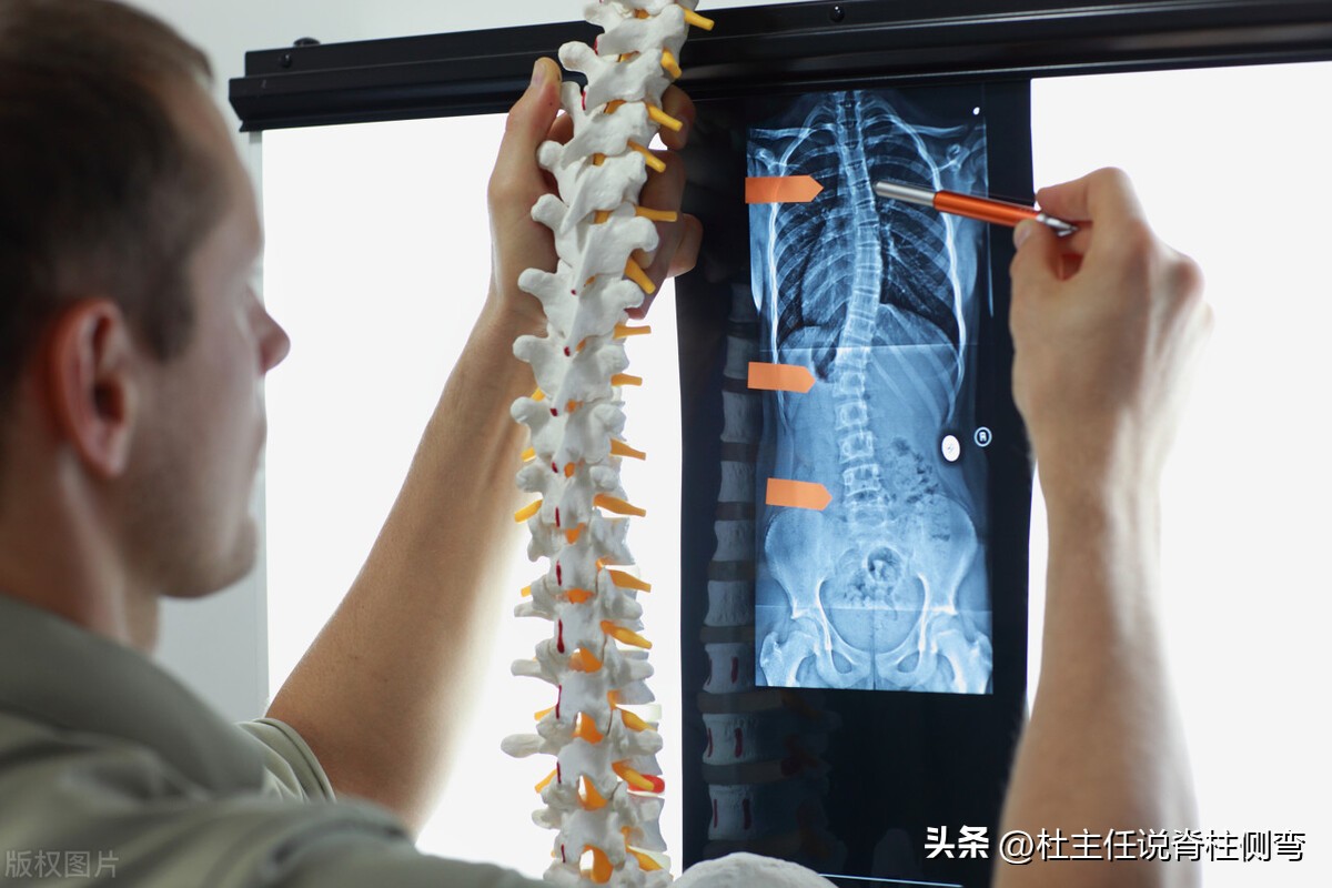 脊柱侧弯十几度有必要戴支具,17岁女孩脊柱侧弯需要佩戴支具吗