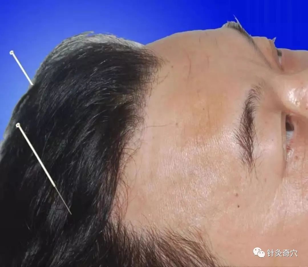 史上最全中医针灸视频教程全集,针灸治疗真实图片大全