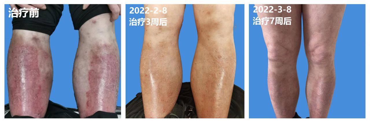 阿达木单抗治疗银屑病用法,银屑病阿达木单抗加重怎么办