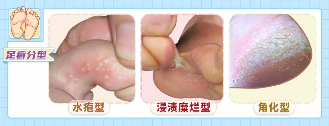 醋加热泡脚能治脚气吗,热水放醋泡脚可以治脚气吗