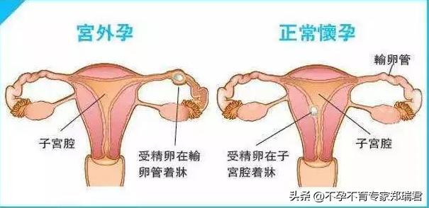 输卵管堵塞只能做试管吗？有没有别的办法？