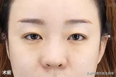 做双眼皮20天大小眼,做双眼皮二十几岁做最好