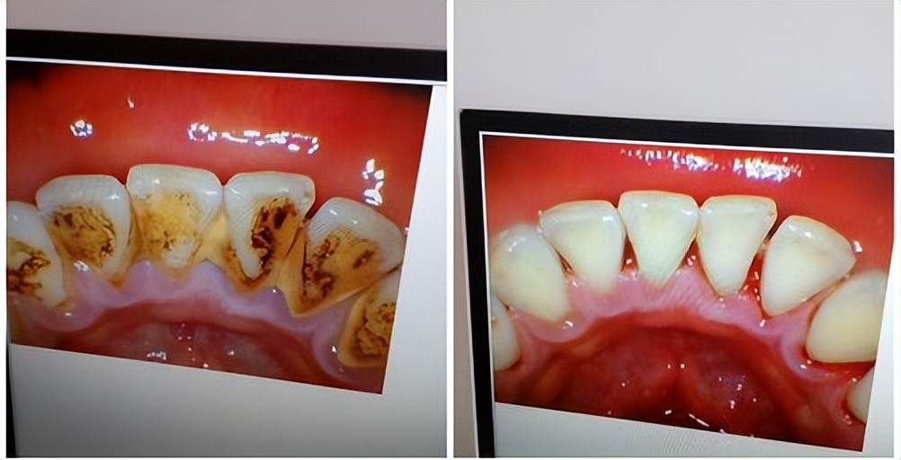 口腔护理牙齿步骤,牙科小常识牙齿敏感