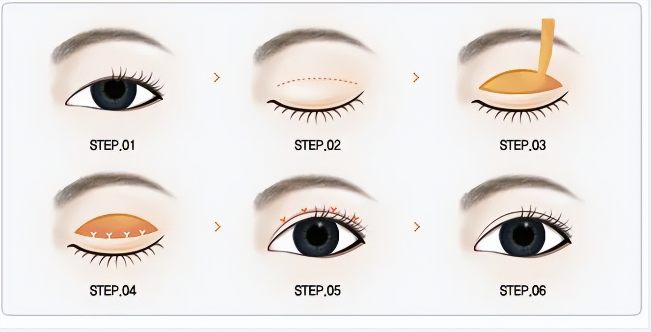 广州做双眼皮好的三甲医院和医生,西京医院双眼皮哪个医生做得好