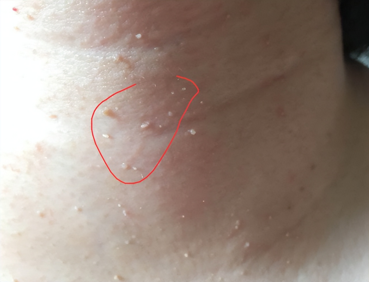 hpv感染代表什么,hpv感染皮肤会出现什么症状吗