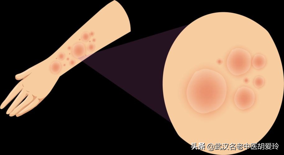 身上起一小块红斑还脱皮是什么原因