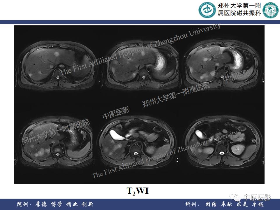 肝脏血管瘤样本,正确认识肝脏血管瘤文章