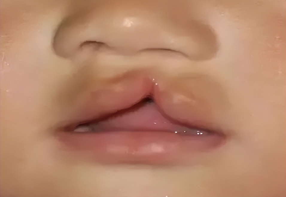 婴儿唇腭裂怎么护理,唇腭裂麻醉