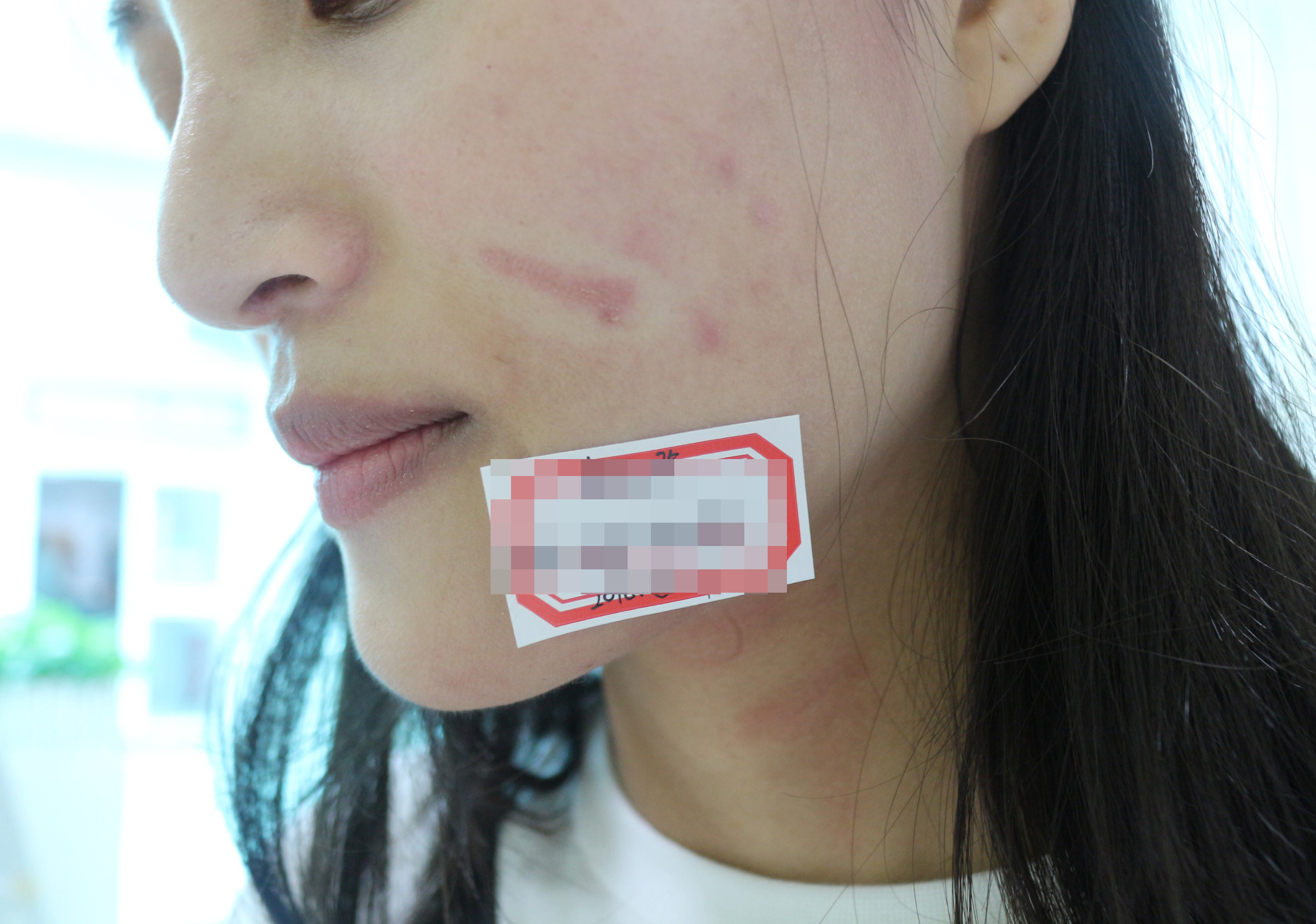 郑州第二中医院疤痕,郑州中医药大学祛疤痕怎样