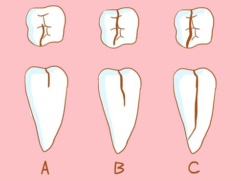 牙痛感觉牙齿如风一样什么情况,平时牙不疼但一嚼东西就疼