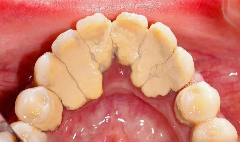 牙缝里的牙结石怎么自己去除,牙缝的牙结石怎么清理