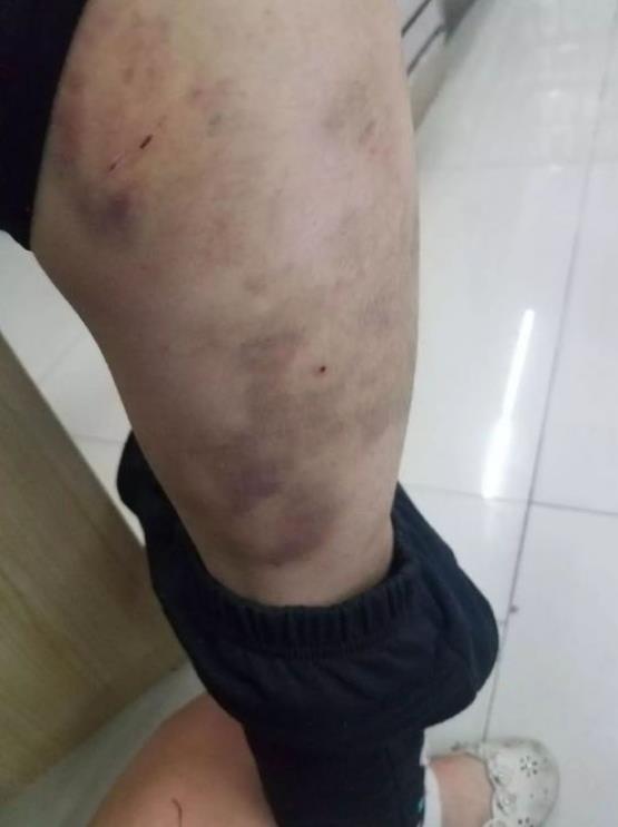 倪海厦治疗紫癜,紫癜如何治疗