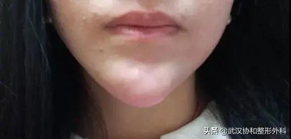 下巴短、后缩、嘴凸看过来！隆下巴了解一下？