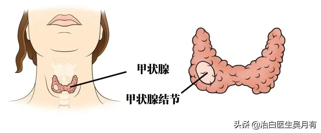 白癜风为什么要检查甲状腺功能,甲状腺引起白癜风是什么情况