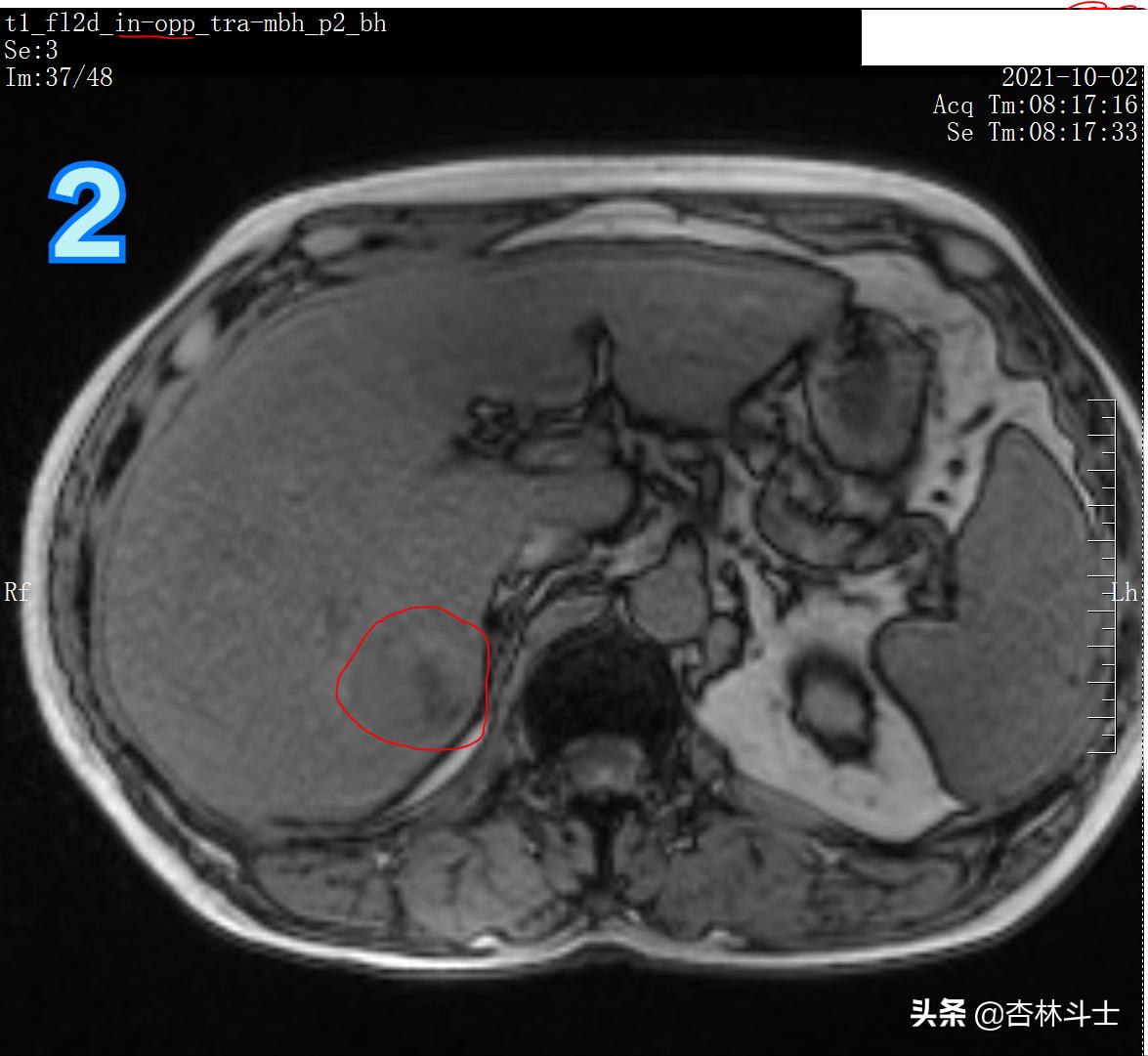 肝癌8公分肿瘤能活多久,肝癌细胞最大长多大