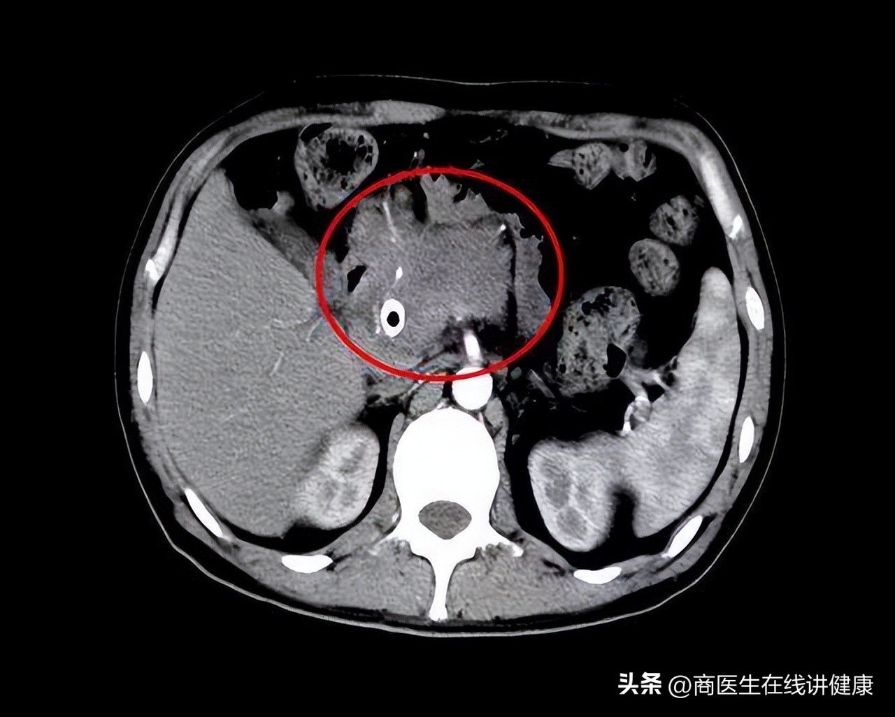 胰腺癌发现就是晚期吗,胰腺癌晚期出现打嗝症状怎么治疗