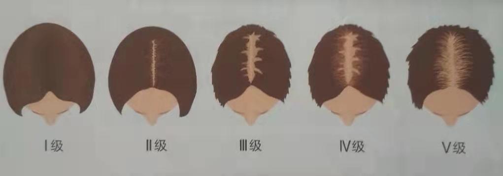 前额脂溢性脱发一招解决,脂溢性脱发如何改善掉头发